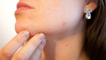 get rid of acne scars
