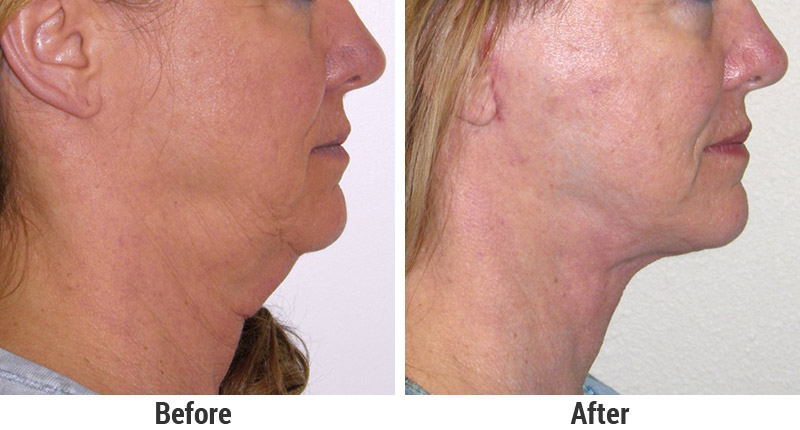 Face and Neck Lifts