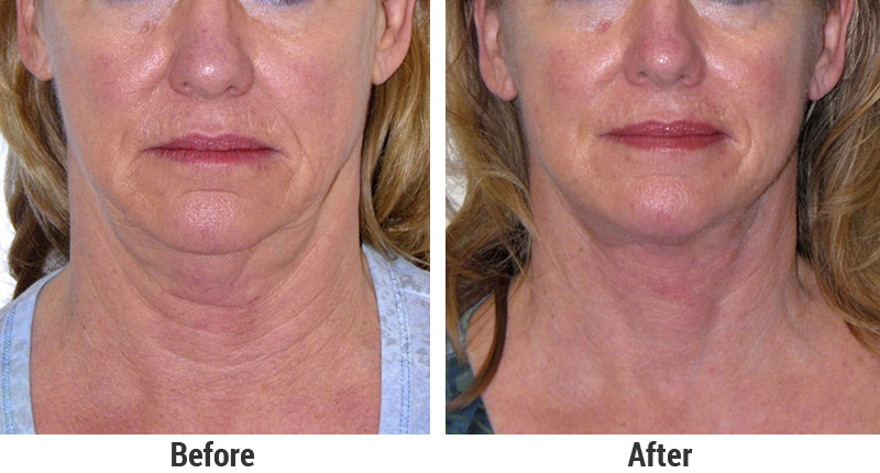 Face and Neck Lifts